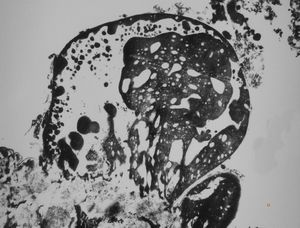 M, 63y. | cyst of choroid plexus - dystrophic calcification M, 63y. | cyst of choroid plexus - dystrophic calcification